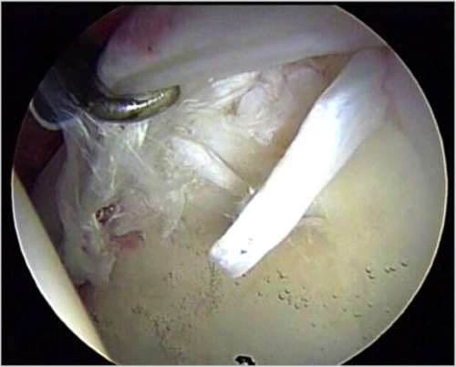 A short curved metal tip enters the upper left of a circular internal surgical view.